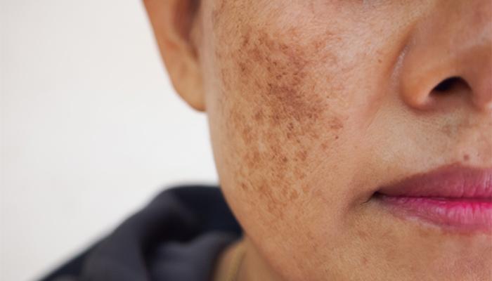How to get rid of dark spots on face?