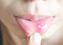 How to get rid of a canker sore