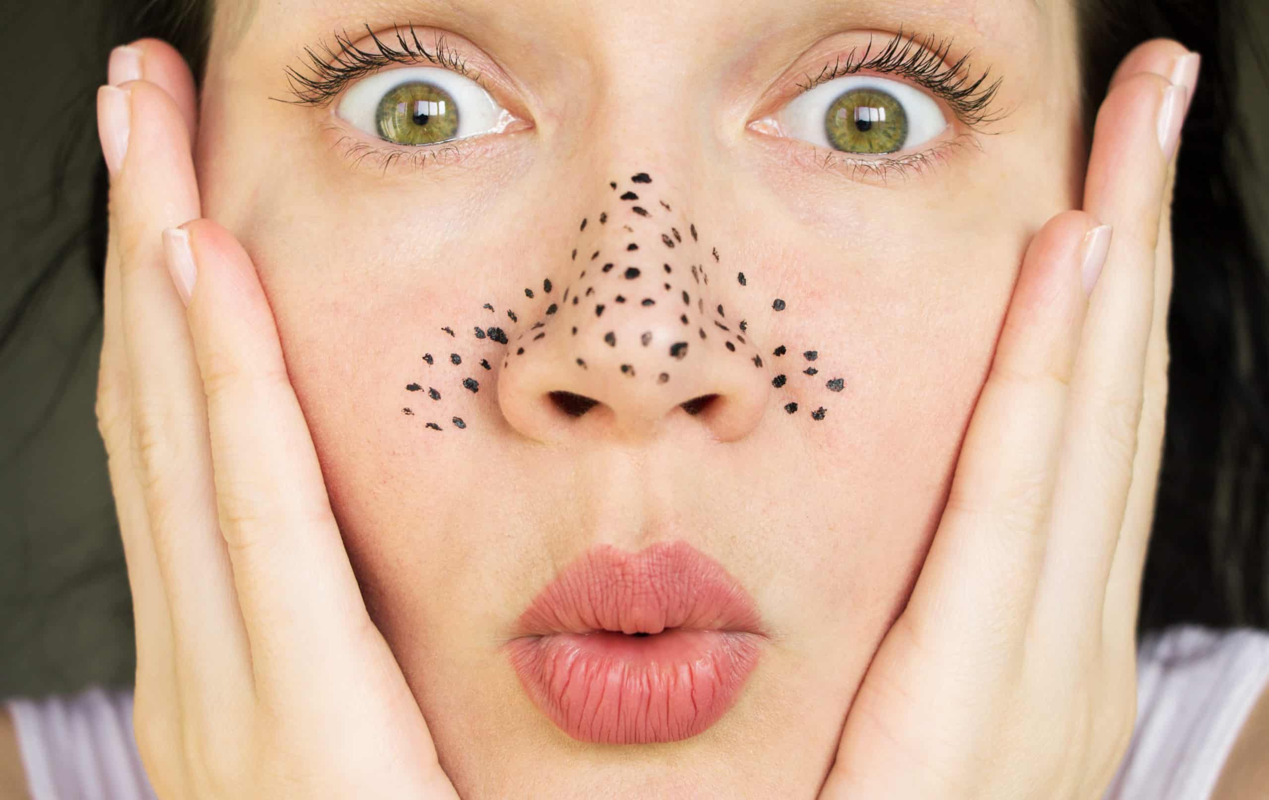 How to remove blackheads