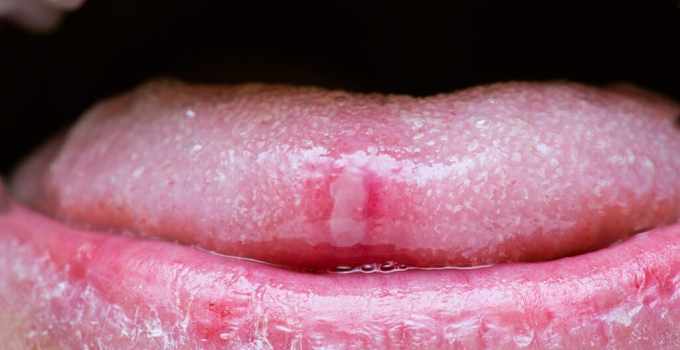 How to get rid of Ulcers?
