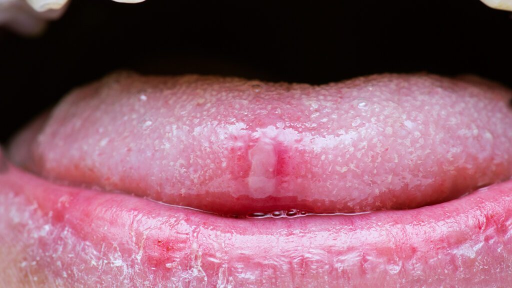 How to get rid of Ulcers?