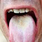 How to get rid of white tongue?