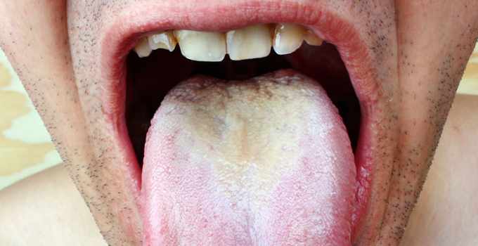 How to get rid of white tongue?