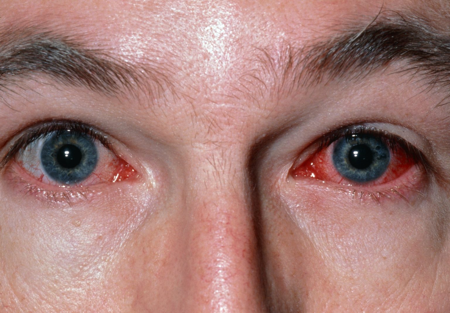 how-long-is-pink-eye-contagious-here-are-signs-to-know