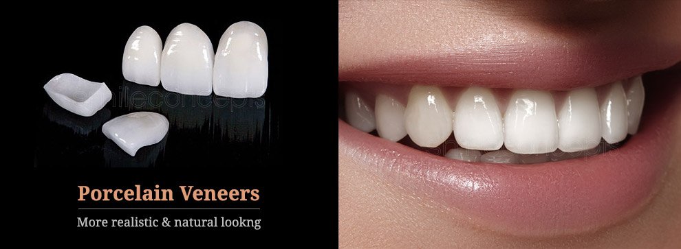 porcelain veneers before and after