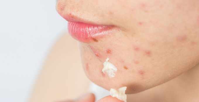 How to remove Pimple marks Naturally at home