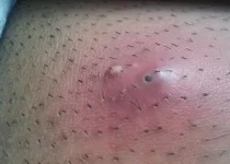 How to remove Ingrown Hair