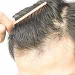 How to stop Hair loss
