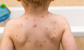 how long does chicken pox last